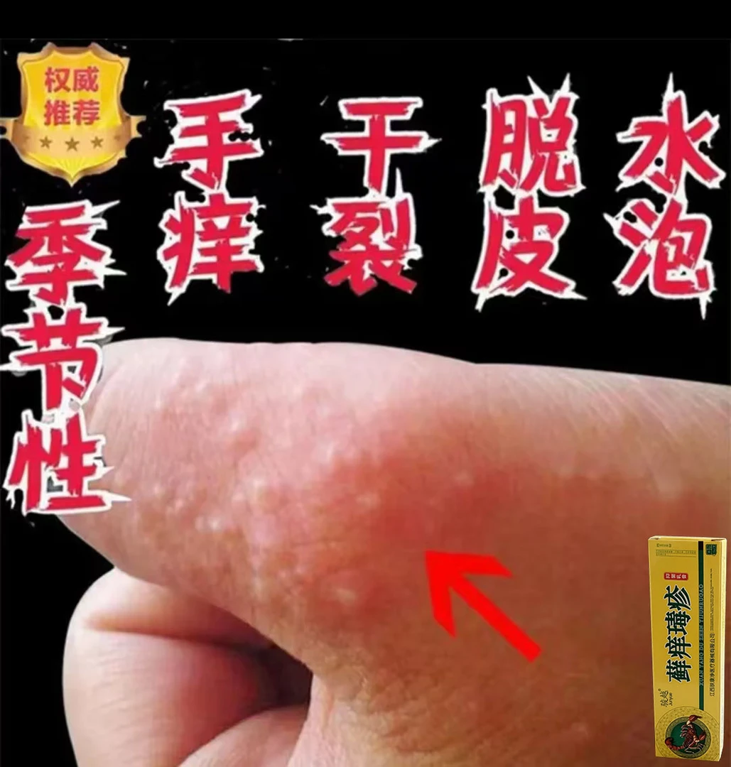 手痒脱皮开裂止痒膏手上真菌感染克星汗庖膏小水泡专用抑菌膏