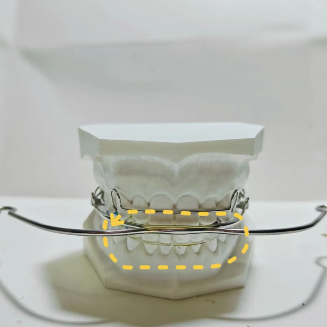 牙齿保持器定做深覆合口外弓肌激动器
