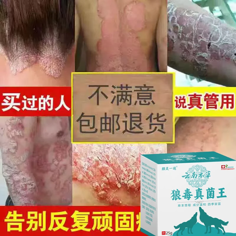 【真菌王】牛皮廯肤顽固手足体股廯红点止痒大腿内侧痒百草止痒膏