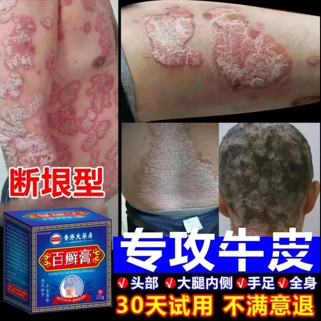 【香港牛皮膏】全身牛/皮/银/屑/鲜手足头体股大腿内侧草本止痒膏