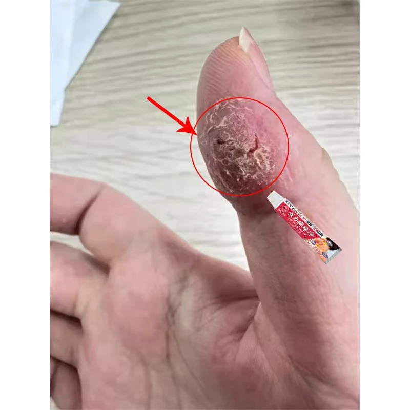 正品强力癣痒净抑菌乳膏脱皮全身皮肤瘙痒强效抑菌止痒乳膏