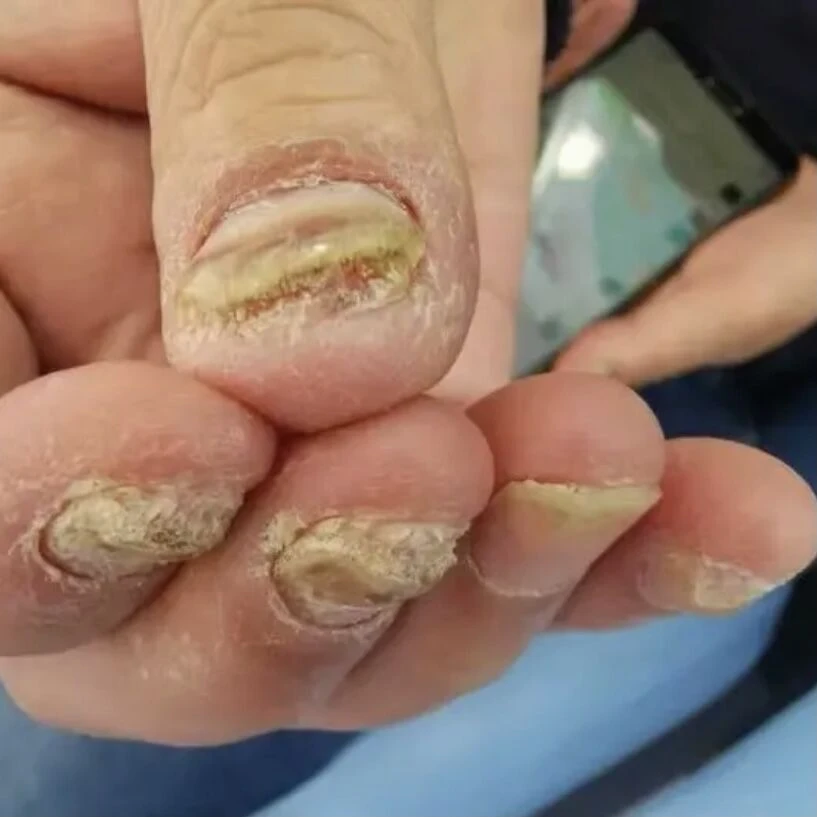 【升级版】指趾甲专用液亮甲抑菌液发灰发黄脚指趾甲正品