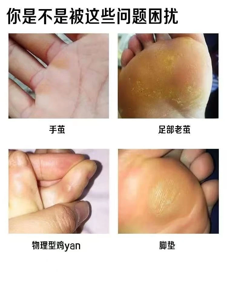 【云南本草】手足部老茧鸡茧植物萃取温和不伤肤快速
