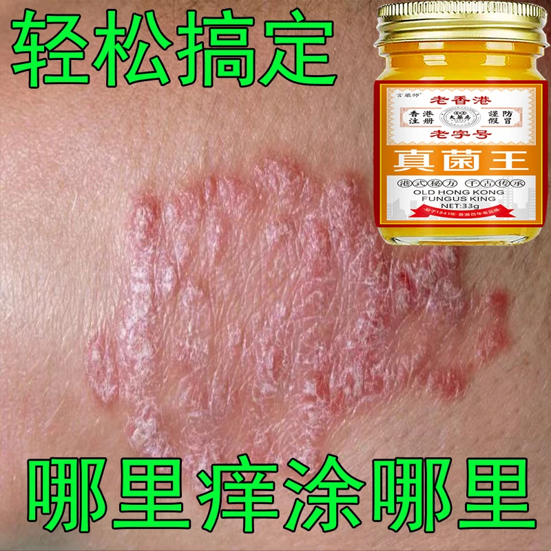 【真菌王】全身牛/皮/银/屑/手足头体股大腿内侧止痒软膏药专用肤癣