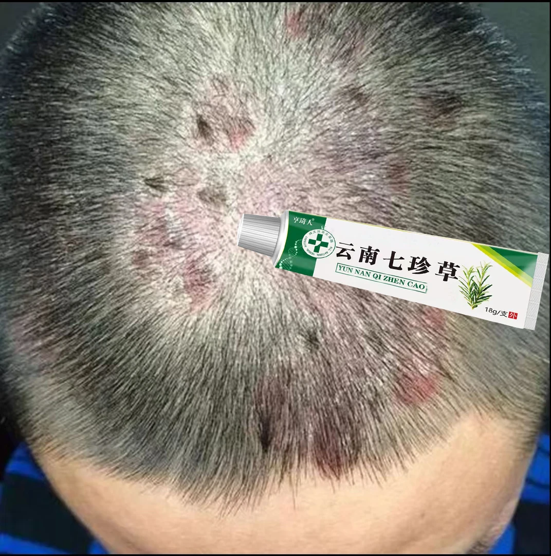 头皮起红疙瘩起脓包长小红痘痘干痒起皮泛红疙瘩毛囊堵塞草本乳膏