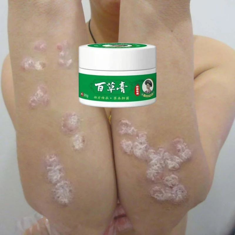 银屑肤瘙痒牛皮廯止痒膏皮真菌王克星体股鲜全身湿痒手足神器专用