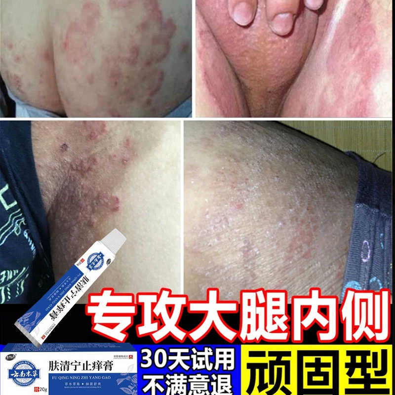 皮肤瘙痒湿痒止膏越抓越痒下体大腿内瘙痒止痒乳膏男抑菌断痒王