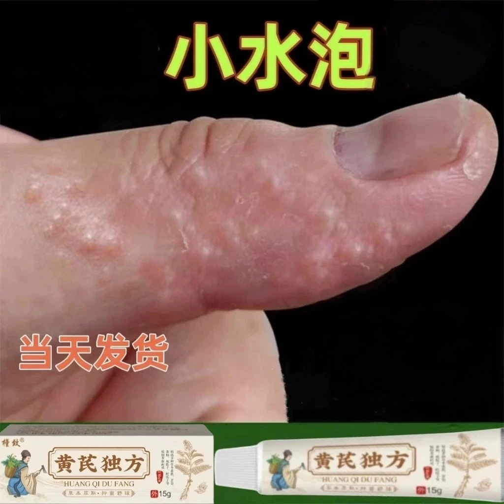 手上长水泡痒抑菌乳膏手指头长水泡珍脚上起水泡痒手上起小水泡痒