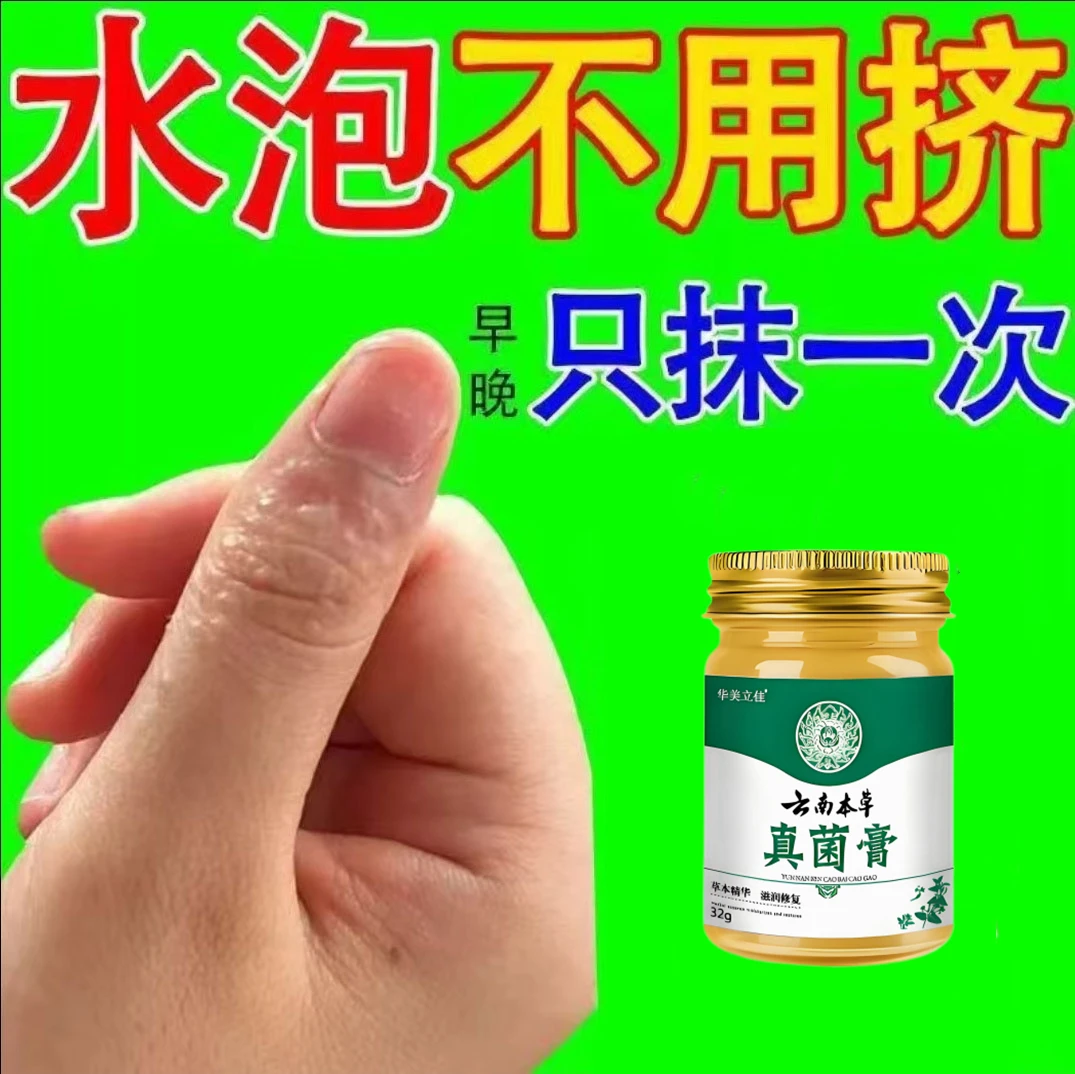 手上起小水萢外用涂抹手指手缝手背红痒脱皮止痒清凉护理草本乳膏