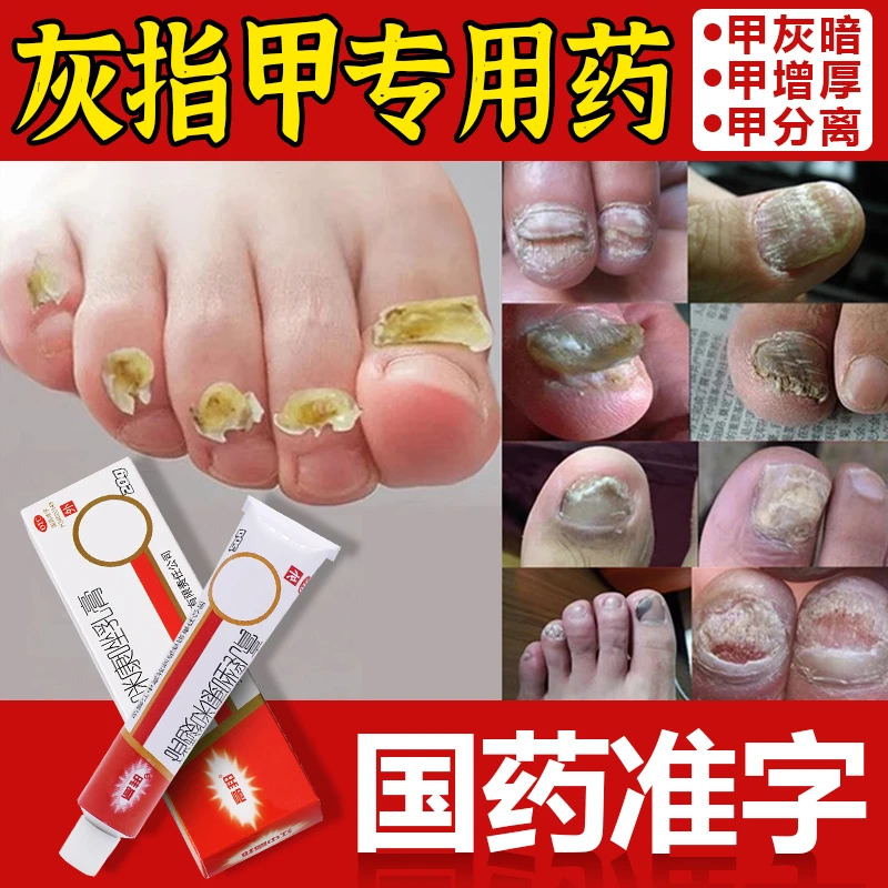 治灰指甲专用药指（趾）甲感染体股癣手足癣花斑癣头癣须癣甲癣皮肤指（趾）甲念珠菌病口角炎外耳炎专用药高邦硝酸咪康唑乳膏2%*20g