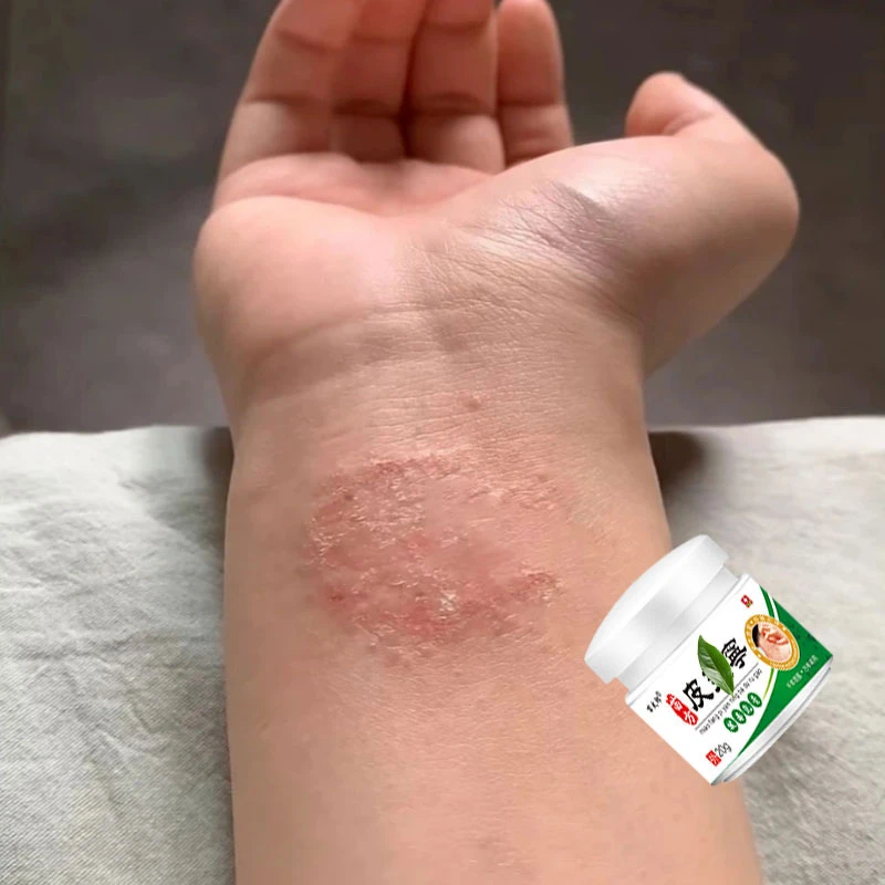 神经性皮肤止痒膏顽固皮手肘足湿痒抑菌乳膏特效草本修复膏