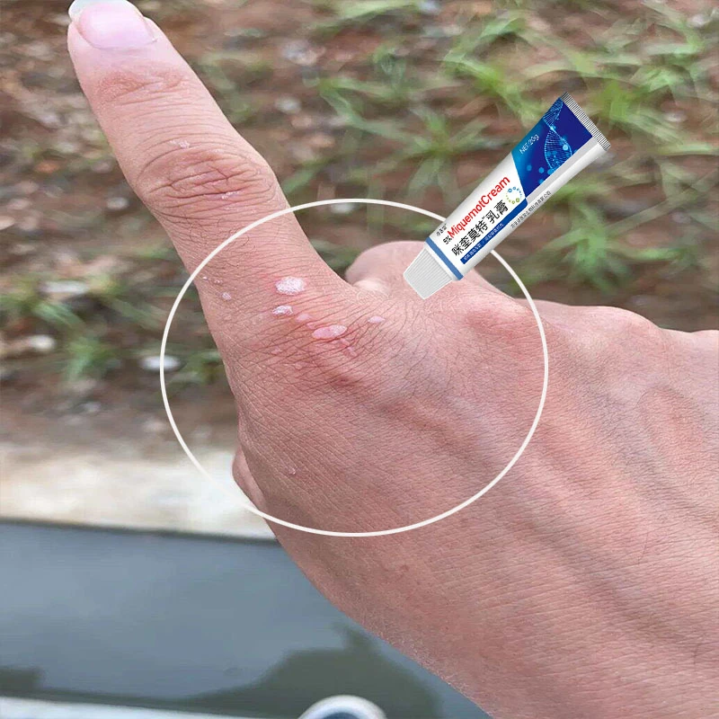 正品咪喹乳膏皮肤手足皮肤表面小肉粒肉钉外用抑菌