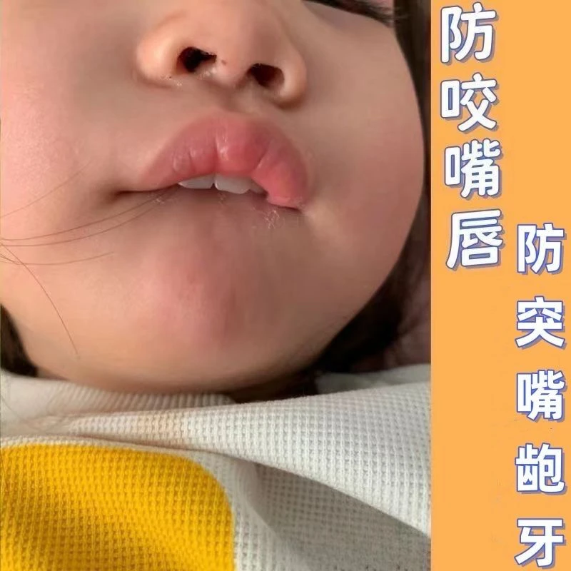 防咬下嘴唇神器宝宝儿童戒吸嘴唇吸手指矫正器适用口呼吸前庭盾