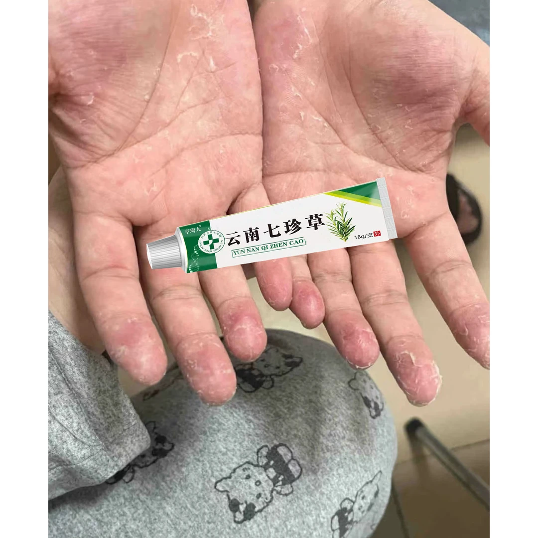 手指长小水泡手部痒手足脱皮手指开裂手指脱皮手足起汗泡抑菌软膏