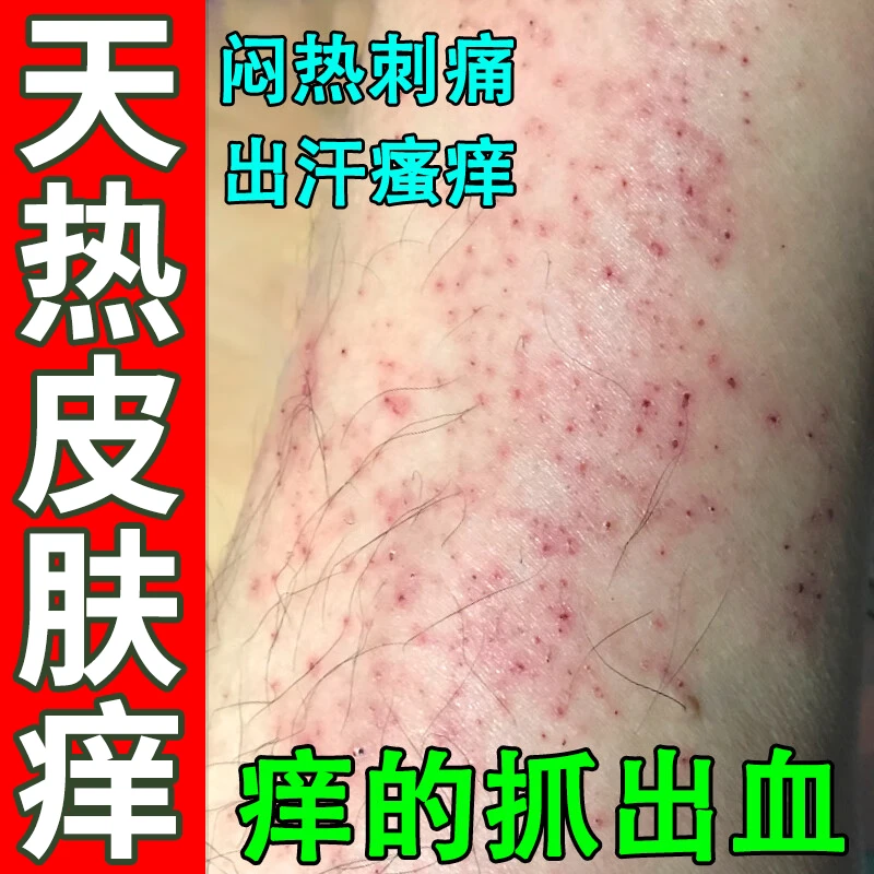 天热身上皮肤痒痒越抓越痒全身小腿天气一热就瘙痒起红疙瘩外用膏