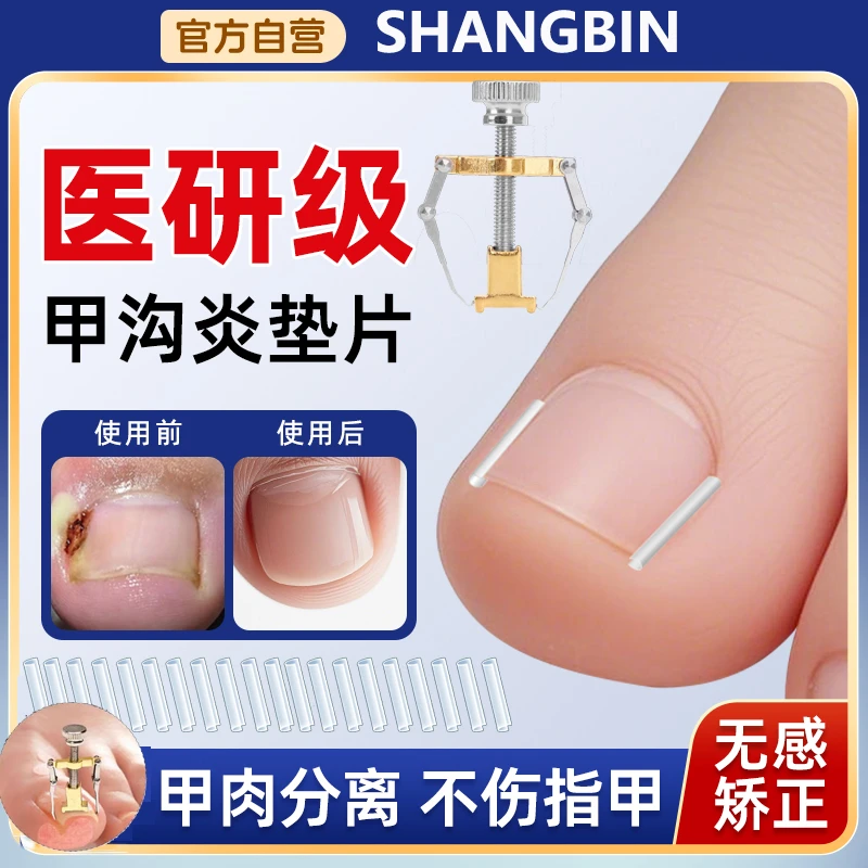 甲沟炎矫正神器嵌甲指甲矫正器脚指甲往肉里长怎么办专用填充垫片