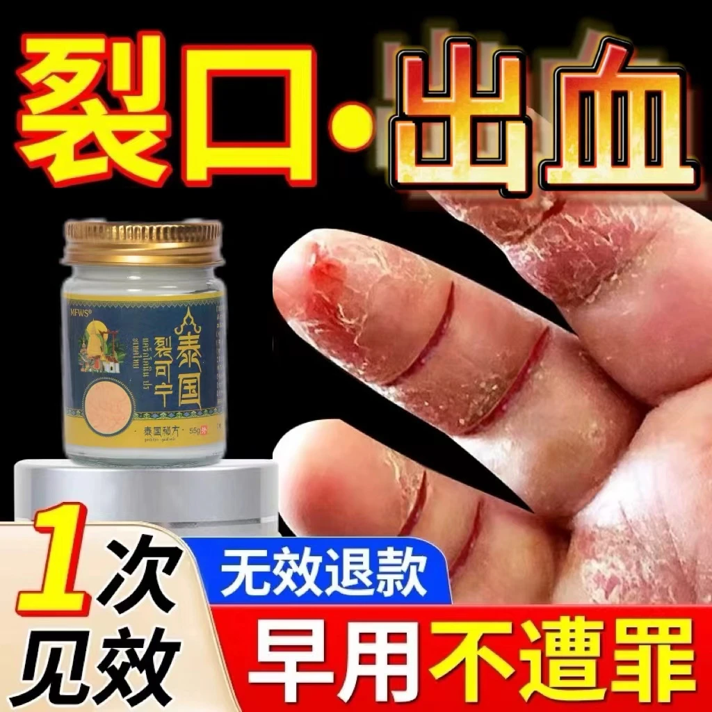 手指头裂口子干裂修复护手霜开裂脱皮裂开手足开口手脚出血严重夫
