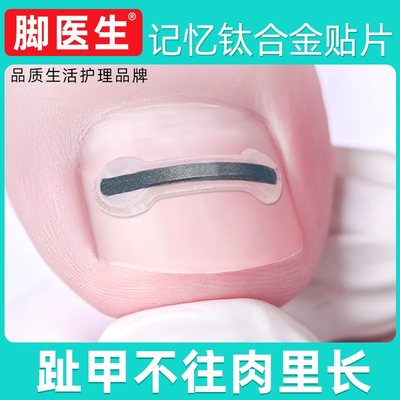 脚医生足部固定器钛合金升级款 嵌甲甲沟炎指甲专用正甲贴