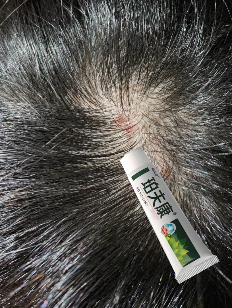 头皮毛囊真菌感染头皮疙瘩痒毛囊堵塞马拉色菌膏头皮斑秃痘坑痘印