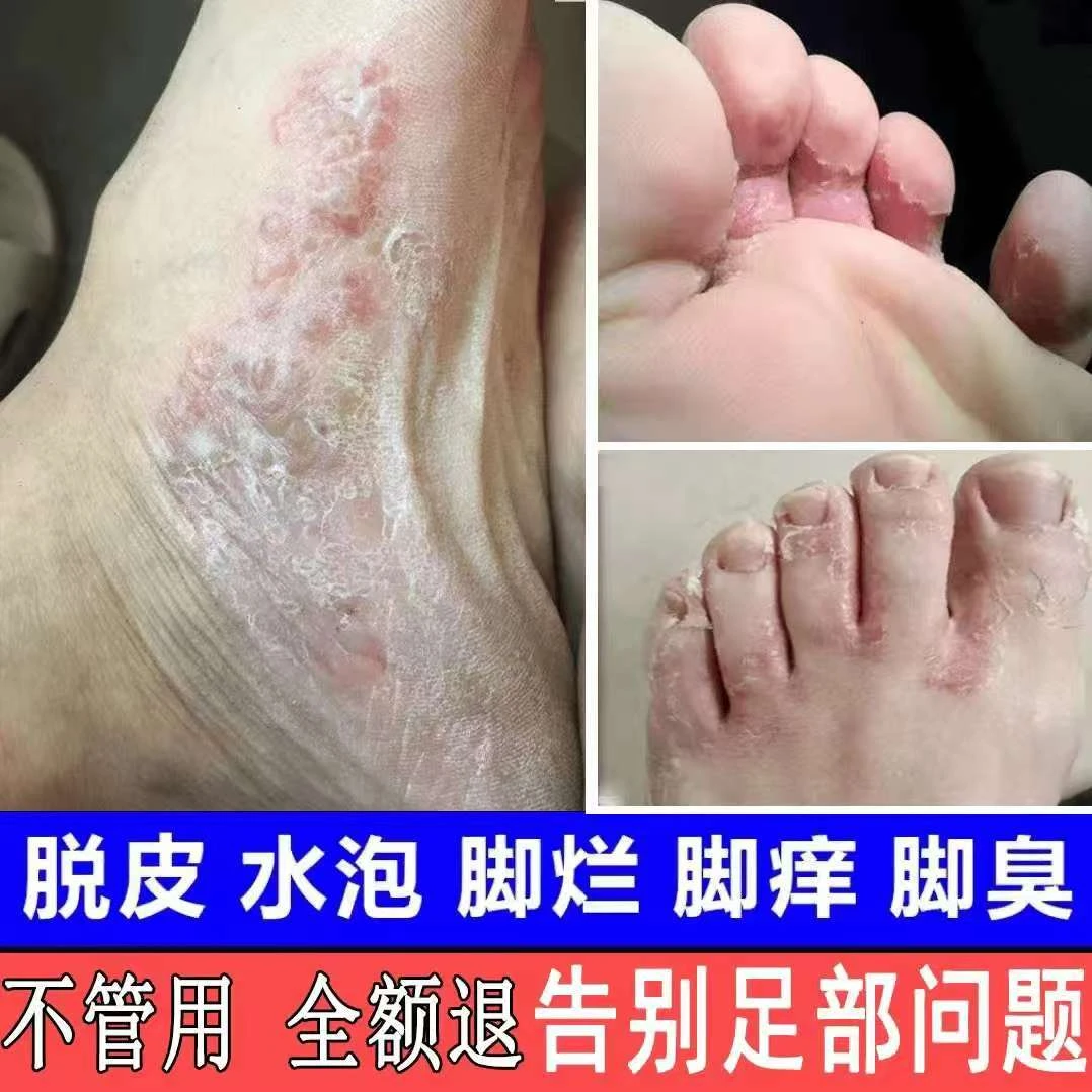 脚痒脚臭止痒膏去脚出汗脱皮起水泡干裂脚趾缝痒喷剂抑菌止痒神器