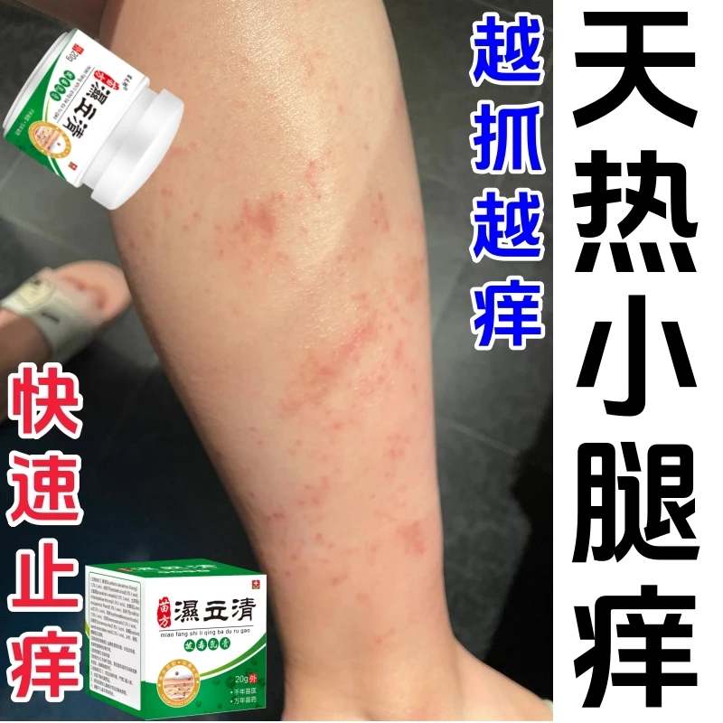 皮肤湿毒痒特效药腿干燥瘙痒湿痒止痒膏春夏越抓越痒出血起红疙瘩