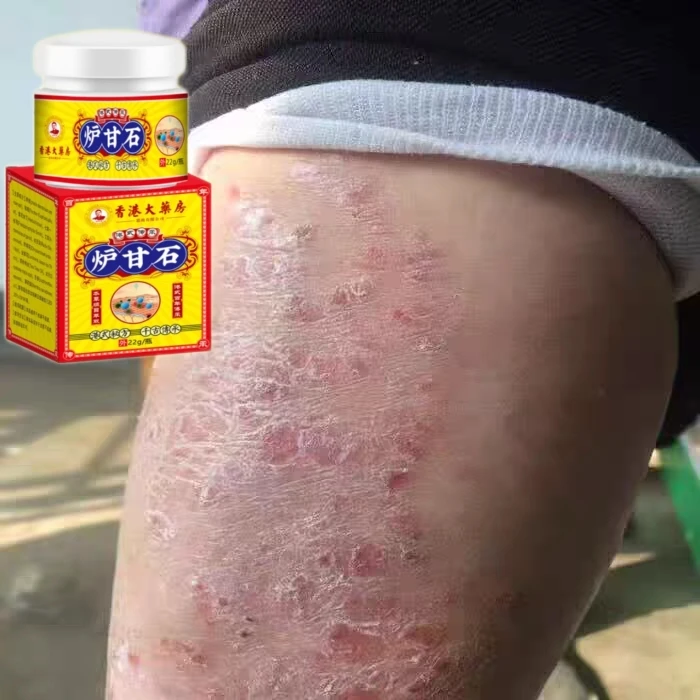 紫草炉甘石皮肤止痒膏抓抓牢牢蚊虫叮咬皮肤起红点痒各种痒