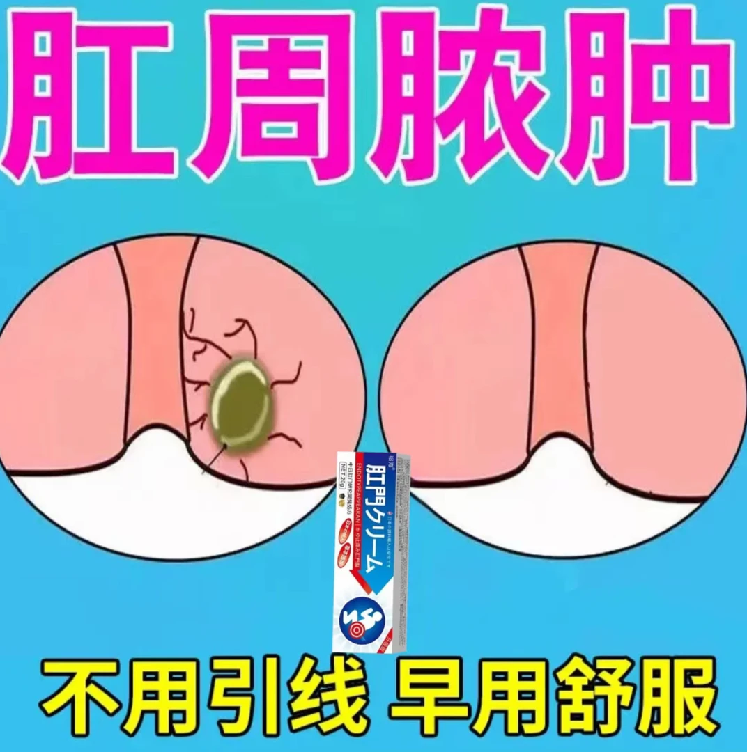 肛瘘肛周脓肿软膏肛周经常疼痛肛瘘硬块外口流脓外用草本膏