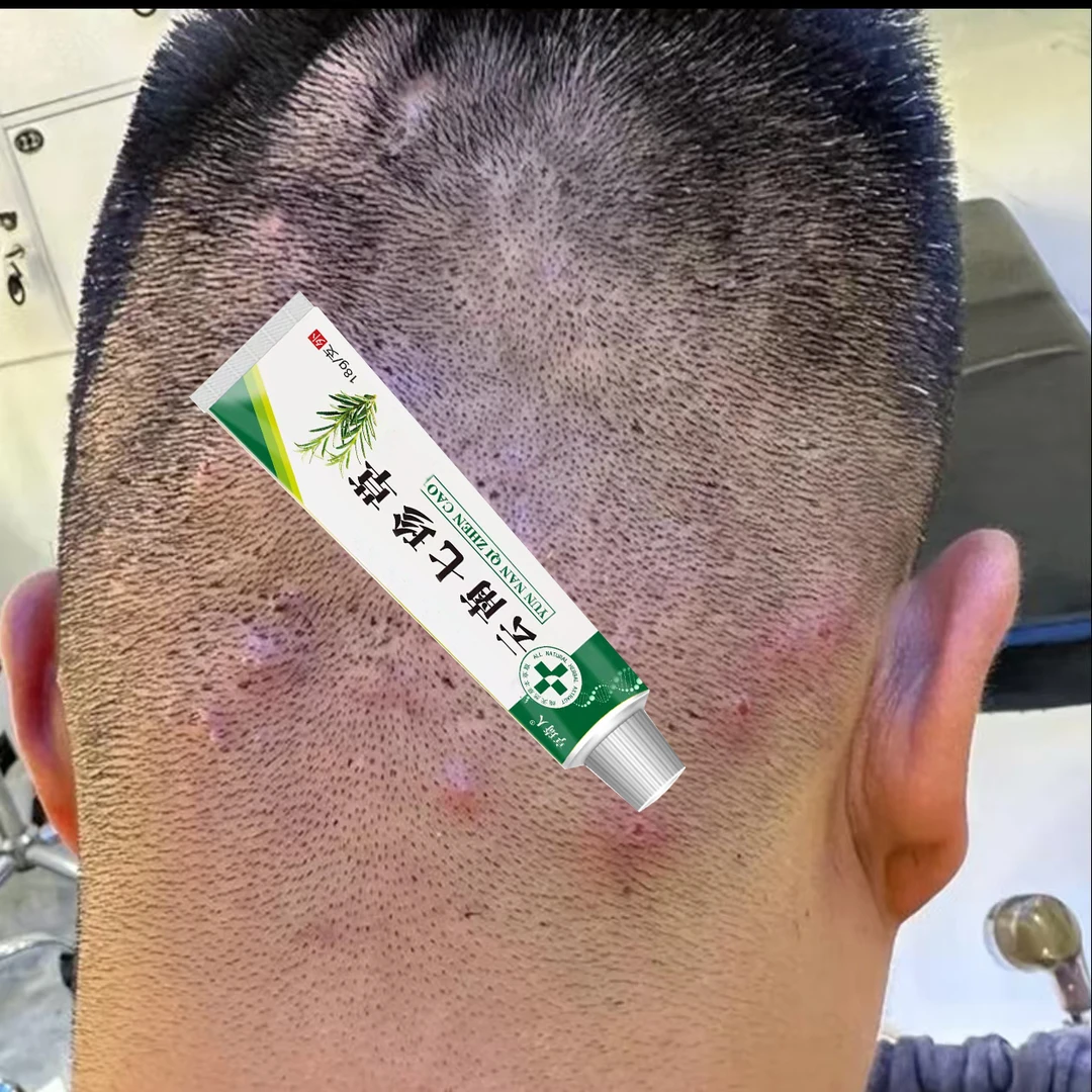 头皮起红疙瘩起脓包长小红痘痘干痒起皮泛红疙瘩毛囊堵塞草本乳膏