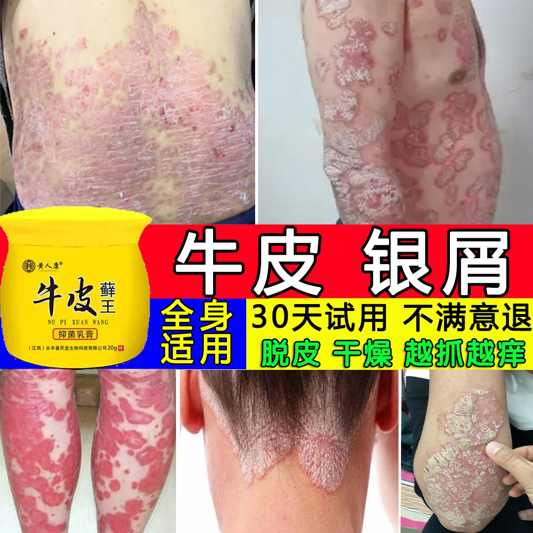 牛专用皮膏顽固银止痒屑膏体股抑菌喷剂大腿内侧瘙痒止痒王神器