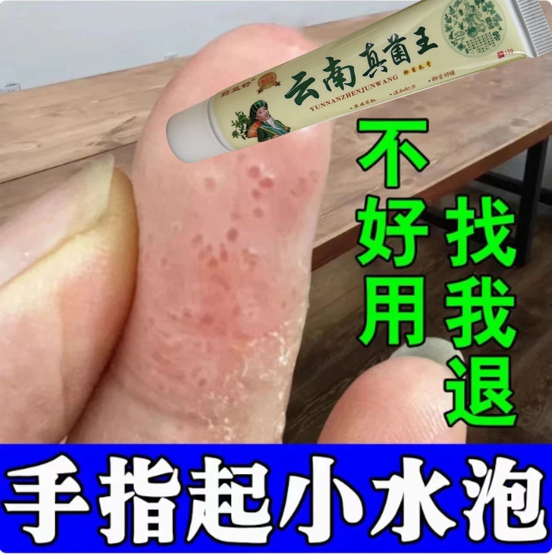 手上起小水·泡汗状水·泡痒手指止痒脱皮专用手足脱皮抑菌膏