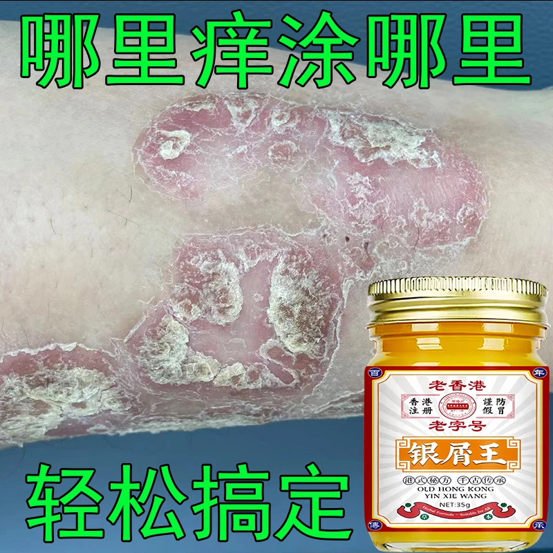 【香港银屑王】皮肤止痒牛抑菌草本温和外用止痒膏