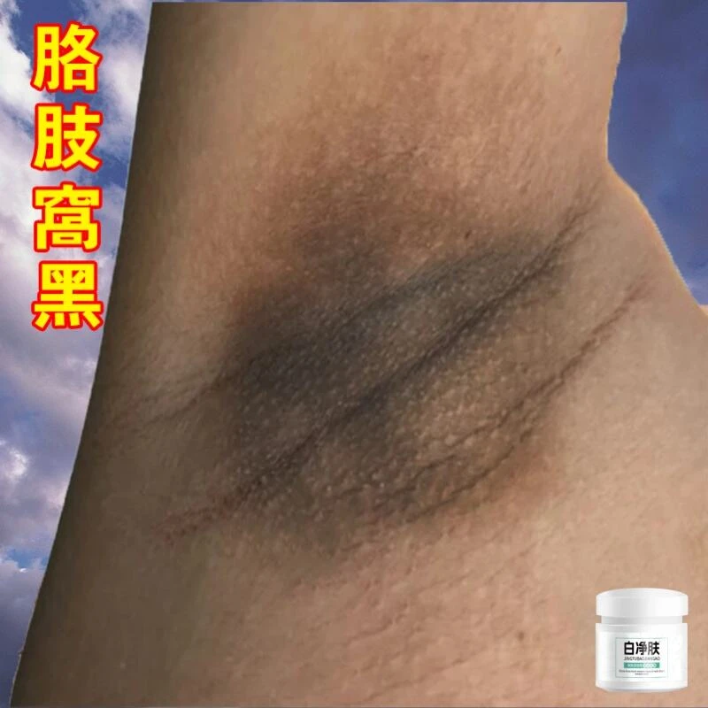 脖子黑棘皮腋下黑久坐屁股黑大腿内侧发黑全身关节黑色素外用膏R