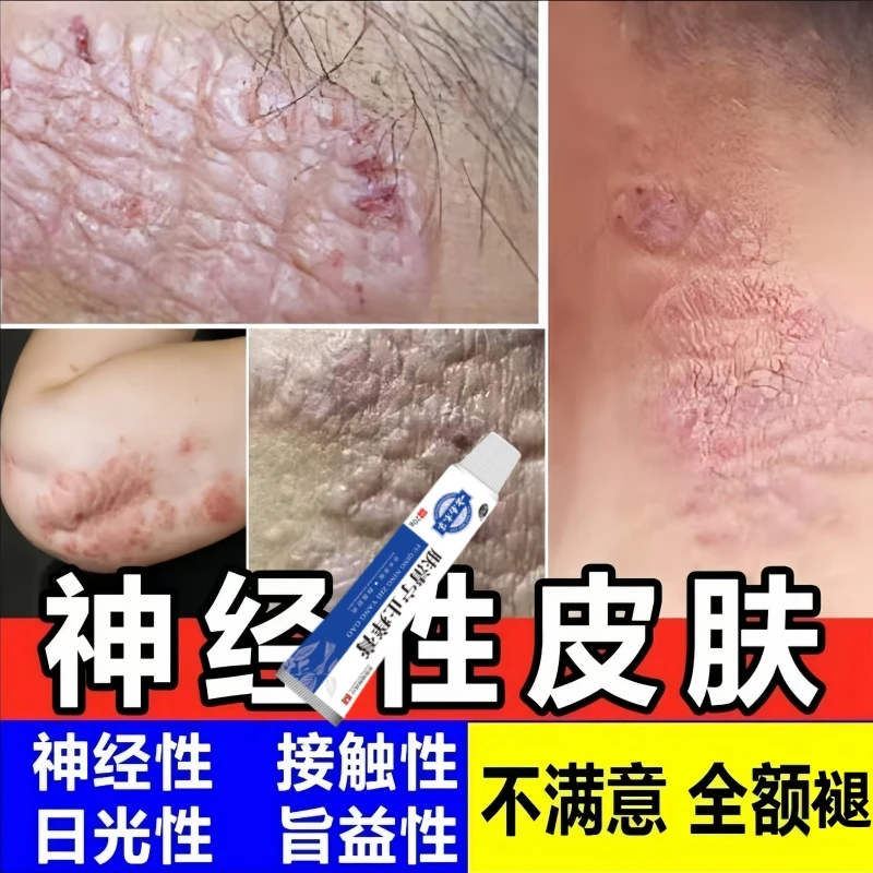 神经性皮肤止痒膏顽固皮手足湿痒全身抑菌乳膏特效修复克星神器