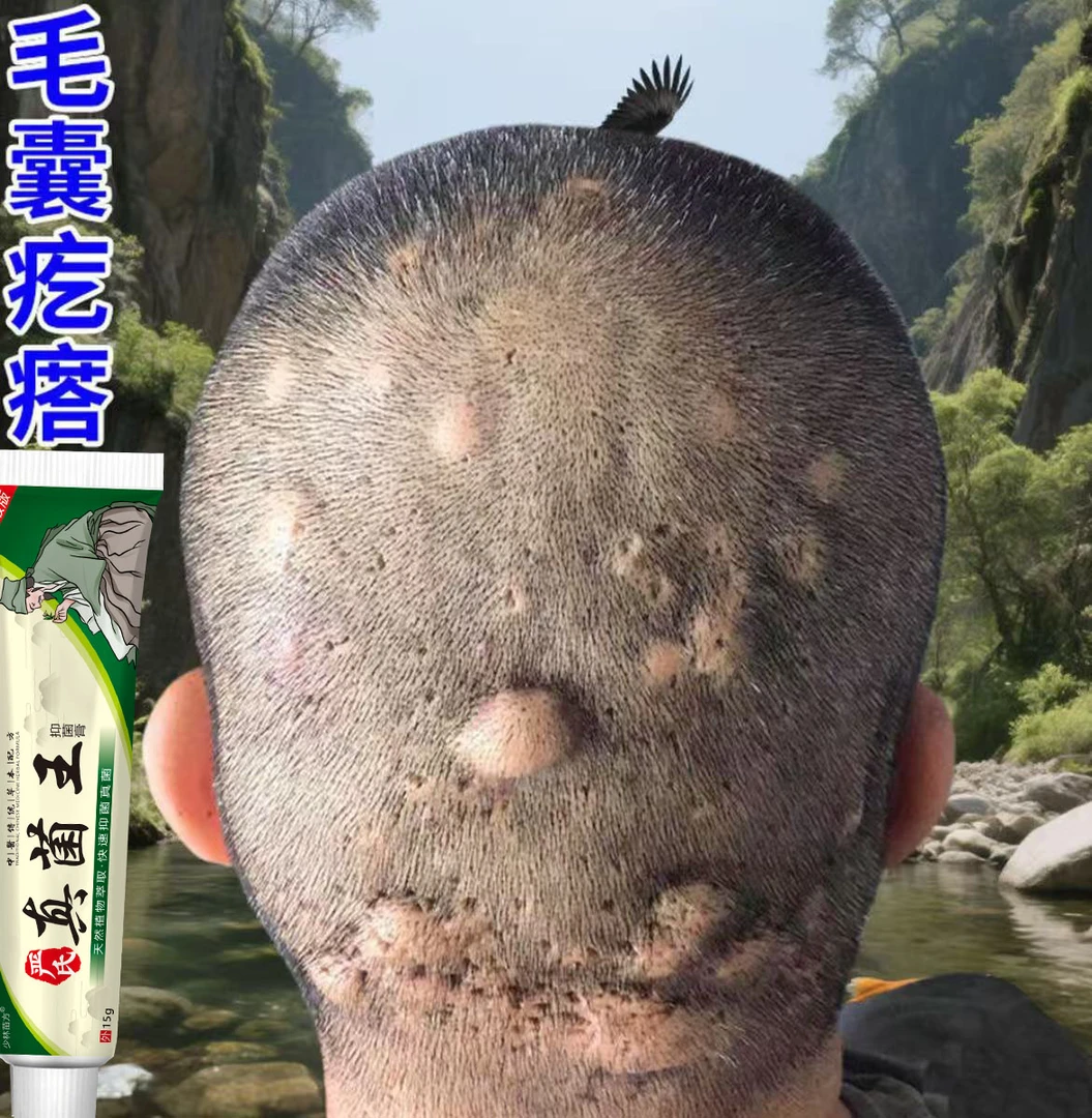 头皮疙瘩前胸后背长痘痘马拉色菌毛囊症状特效头皮小脓包怎么消除