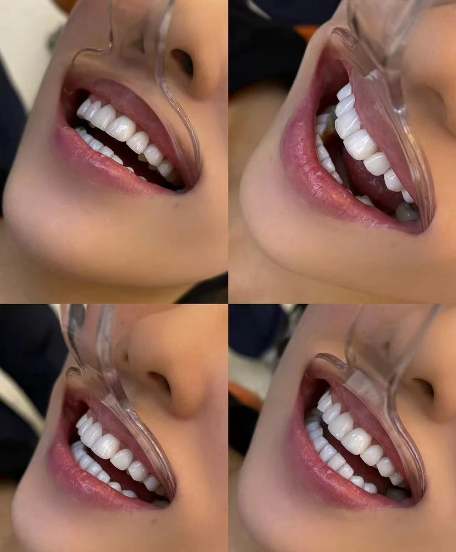 炫白牙贴炫白牙贴