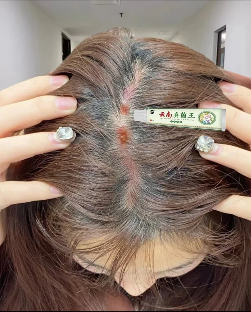 头皮毛囊起小红疙瘩脓包头屑长痘痘头部毛囊专用止痒膏正品特效