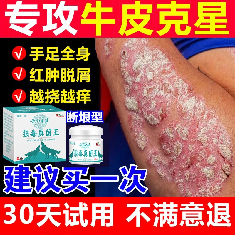 【狼毒百廯膏】牛皮廯肤顽固手足体股廯红点止痒大腿内侧痒止痒膏