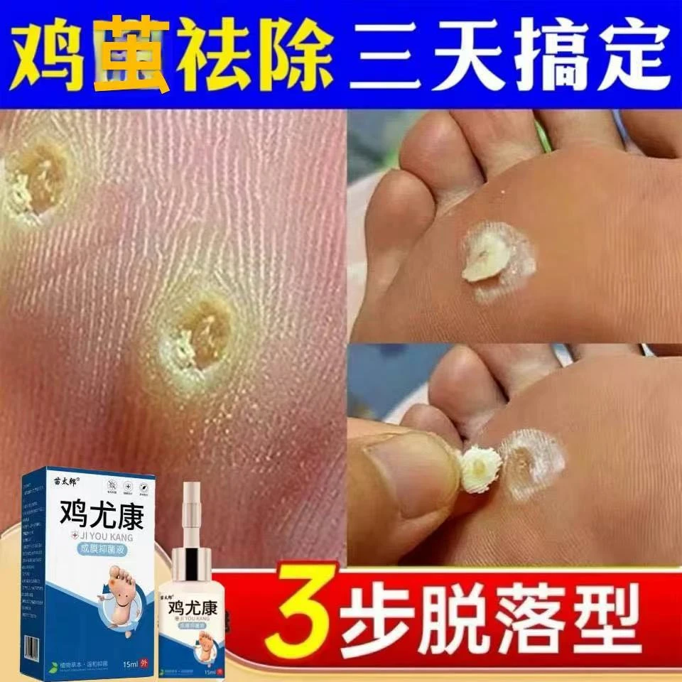 鸡尤康去鸡茧老茧无痛肉刺手茧小脚趾关节茧脚底脚垫云南脚部本草