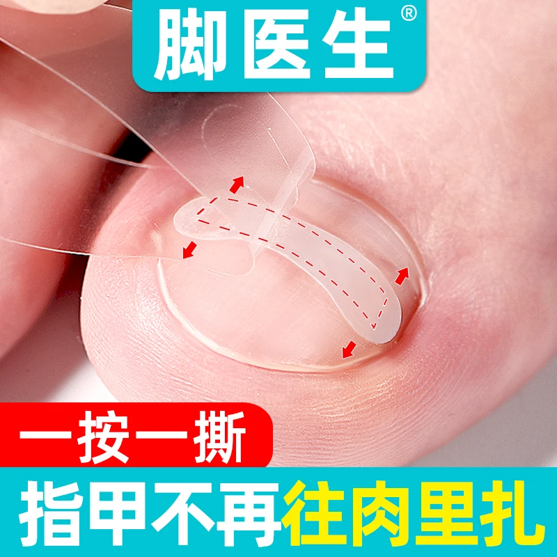 脚医生正甲贴套装矫正器亮甲垫片神器防水护理超薄无痕专用胶简便