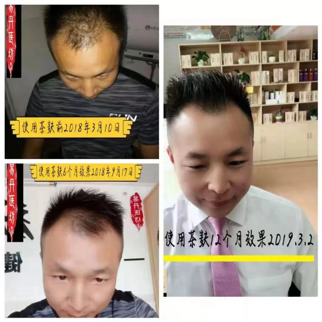 易丹壹坊 防脱液(假一赔百)送6包茶麸体验装