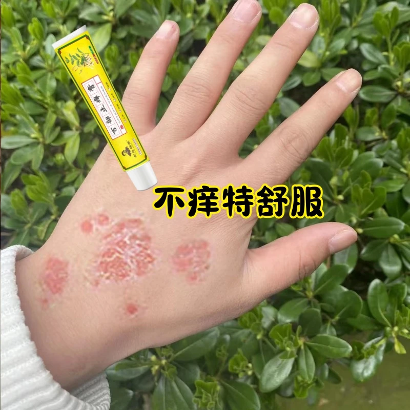 手上腿上胳膊上起疙瘩潮湿痒小腿身上痒起皮大腿痒草本止痒抑菌膏