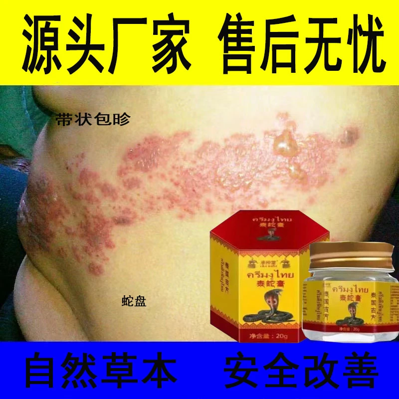 泰国泰蛇膏蛇盘带状神经后遗改善多年顽固纯天然植物深处萃取