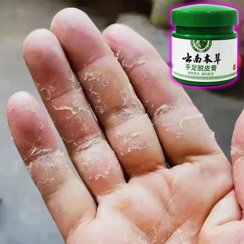 云南本草手足脱皮膏20g/盒 草本萃取涂抹温和外用手脚部脱皮干裂