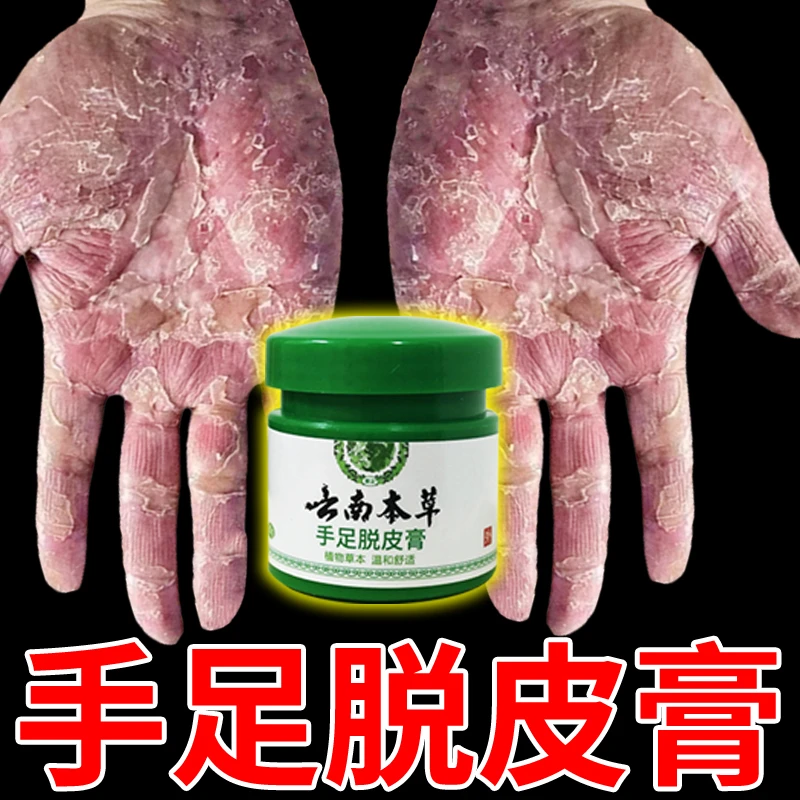 云南本草手足脱皮膏20g/盒 草本萃取涂抹温和外用手脚部脱皮干裂