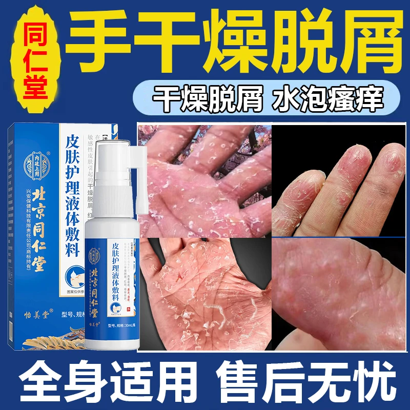 内廷上用手足脱皮膏手起水泡痒脱皮干裂瘙痒皮肤护理液体敷料
