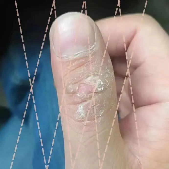 手指关脱皮痒手指关节长硬疙瘩脱皮干裂手痒鹅掌风干裂滋养防干