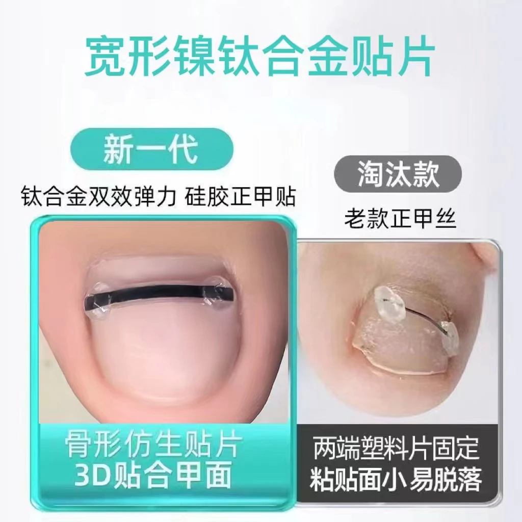 大人小孩都能用嵌甲矫正正甲贴 甲沟炎嵌甲矫正神奇