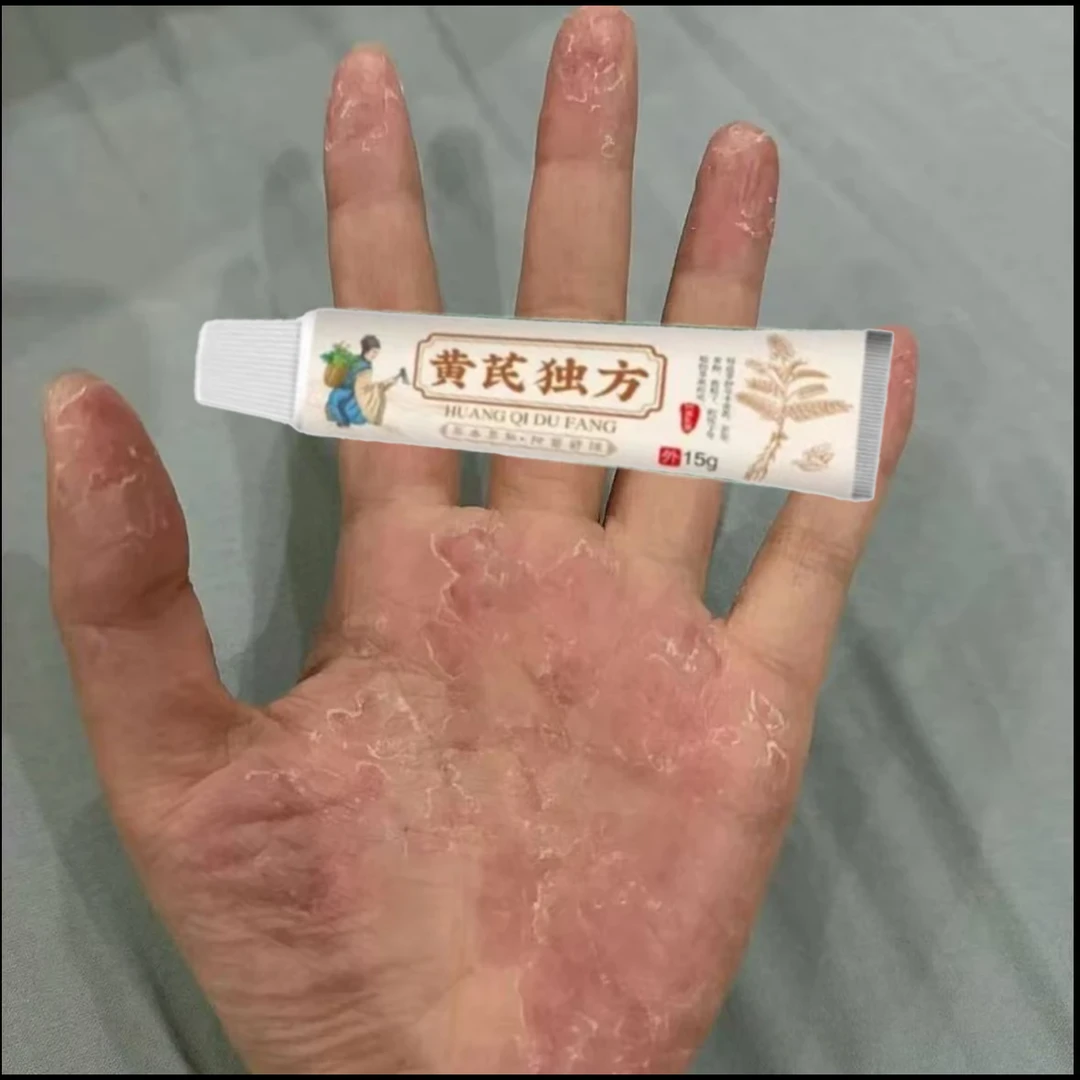 手上长水泡痒抑菌乳膏手指头长水泡珍脚上起水泡痒手上起小水泡痒