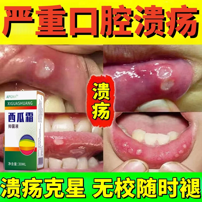 【烂嘴喷剂】口腔溃疡反复烂嘴巴嘴内口舌生疮西瓜霜喷剂