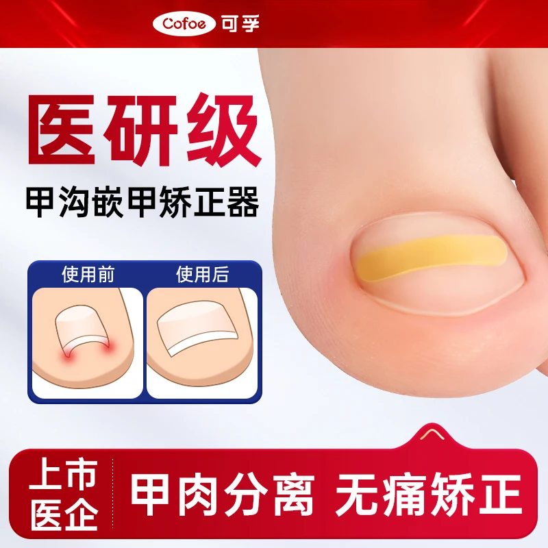 可孚嵌甲修甲矫正器专用指甲贴片脚趾甲重度正甲贴脚趾内嵌甲沟炎